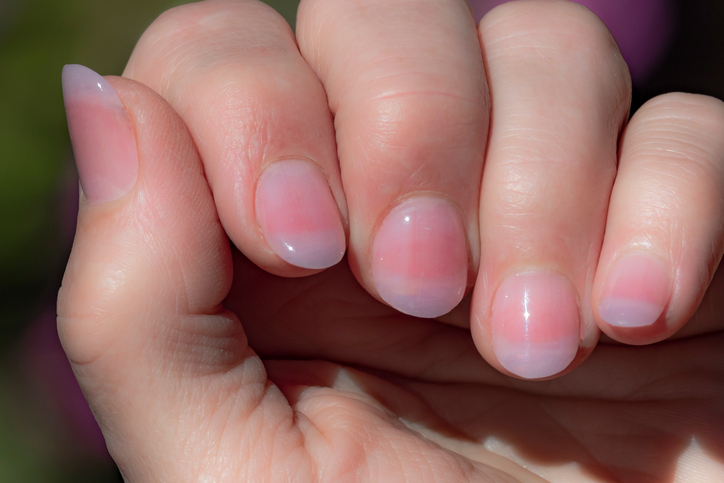 This Woman Had No Idea That Her Nail Was Showing A Side Effect Of Lung