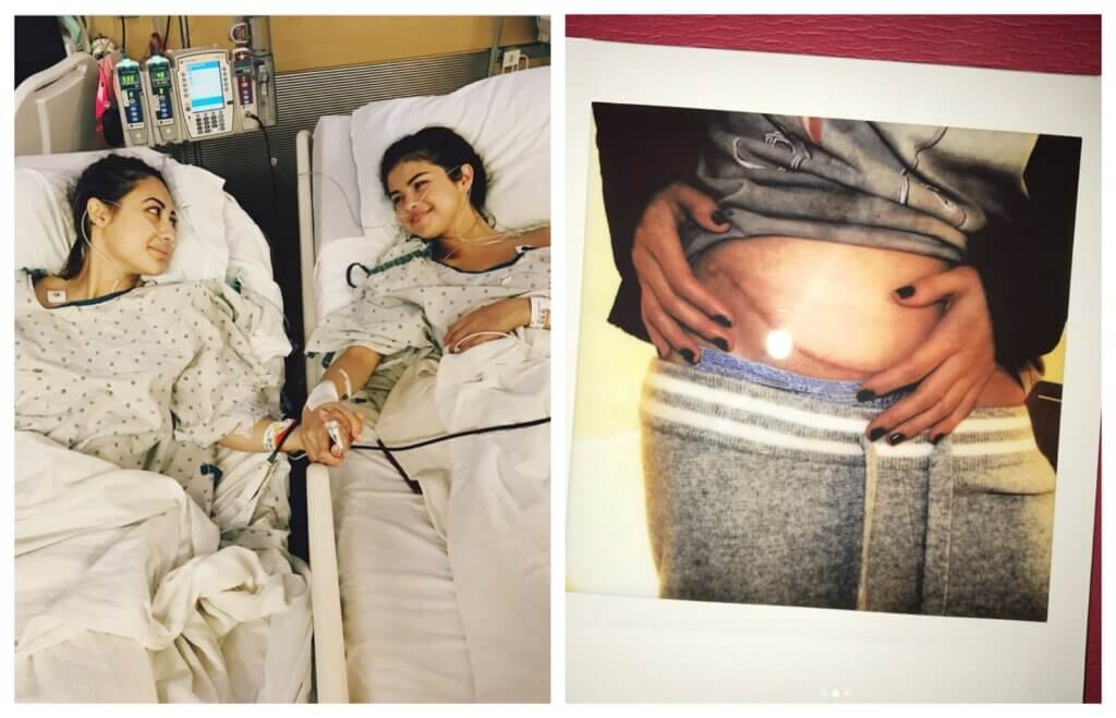 side-by-side comparison of two posts from Selena Gomez's instagram. in one, she lies in a hospital bed next to her friend, holding hands. In the other, it shows her scar.