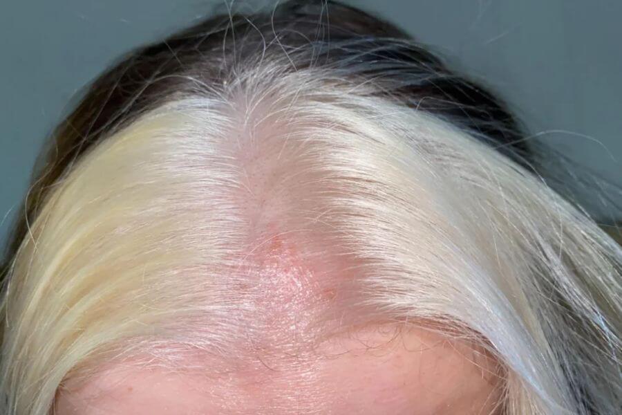 A close up of the top of a woman's head showing chemical burns