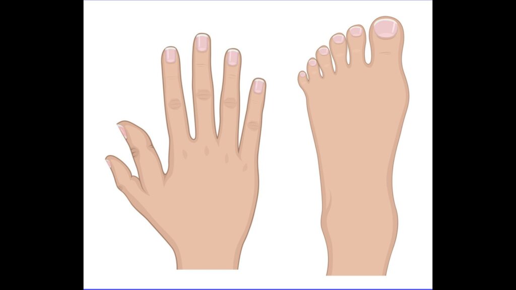 Illustration of Polydactyly of the foot and hands of an adult.