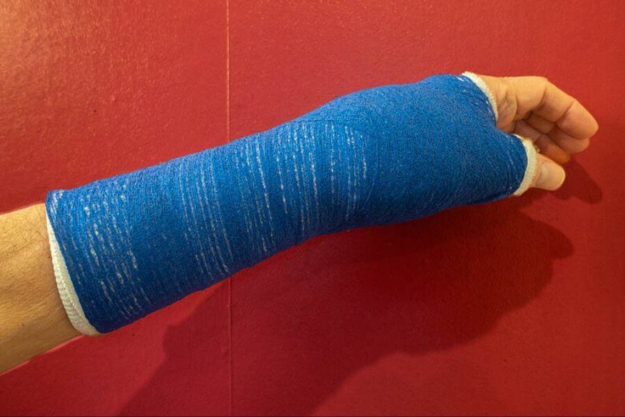 arm cast