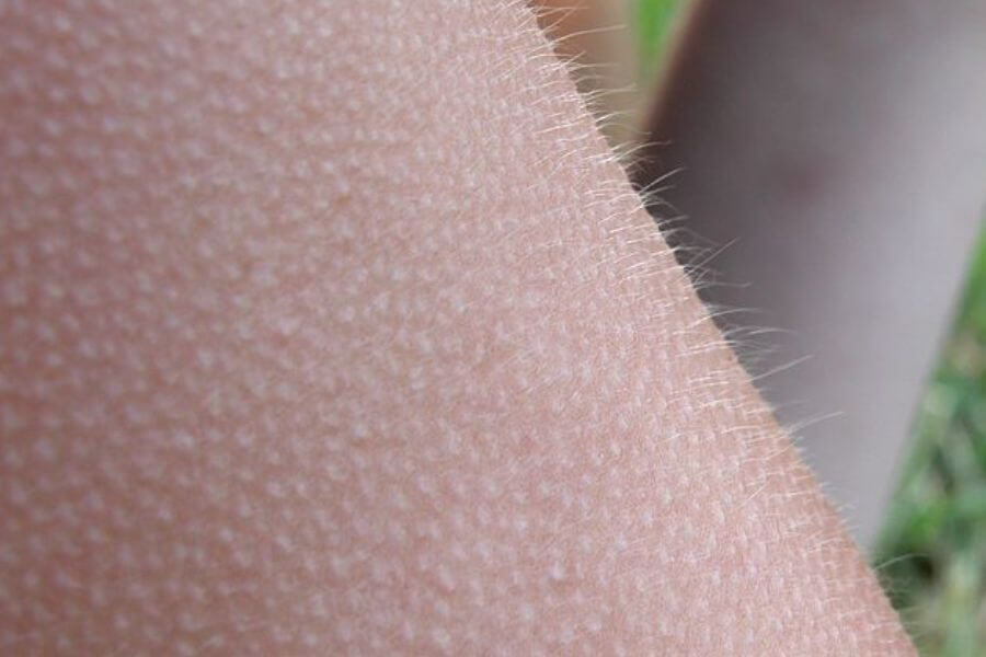 arm with Goosebumps