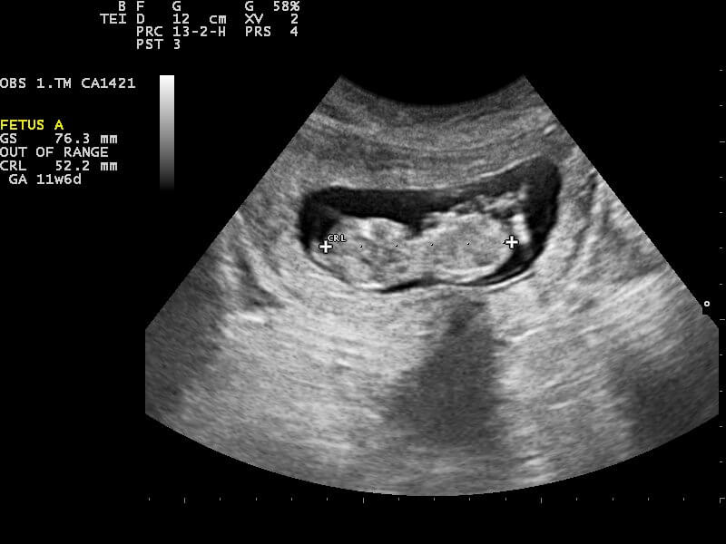 A black-and-white ultrasound scan displaying a developing fetus labeled "FETUS A." The on-screen measurements indicate a gestational age of approximately 11 weeks and 6 days, with various fetal dimensions marked.