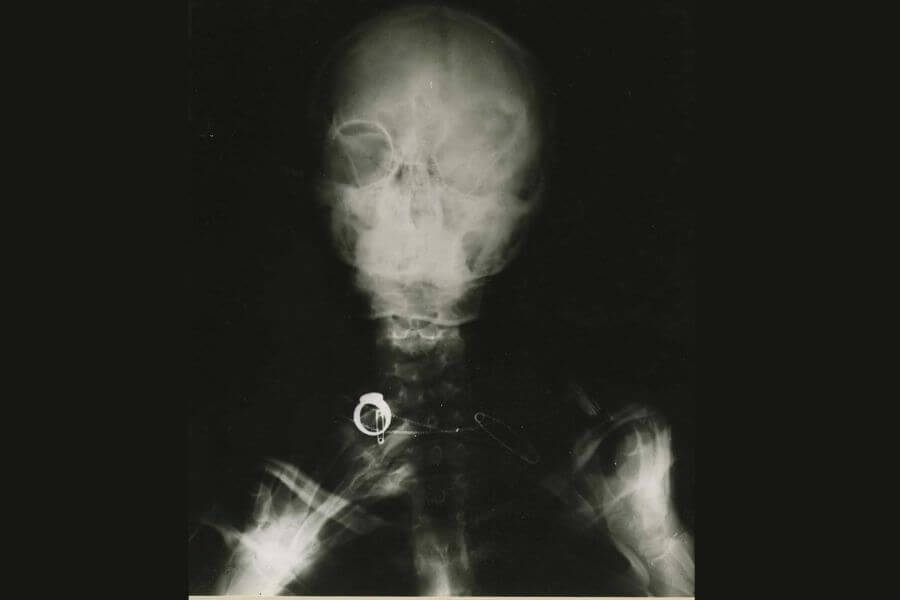 A black and white X-ray image of a human skull and upper torso. The scan reveals skeletal structures with some abnormalities or damage, possibly due to radiation exposure. A metallic object, resembling a ring or medical implant, is visible near the throat area, along with a safety pin. The image appears to be from a historical medical study