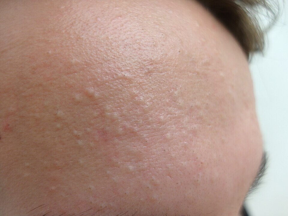 Acne on forehead