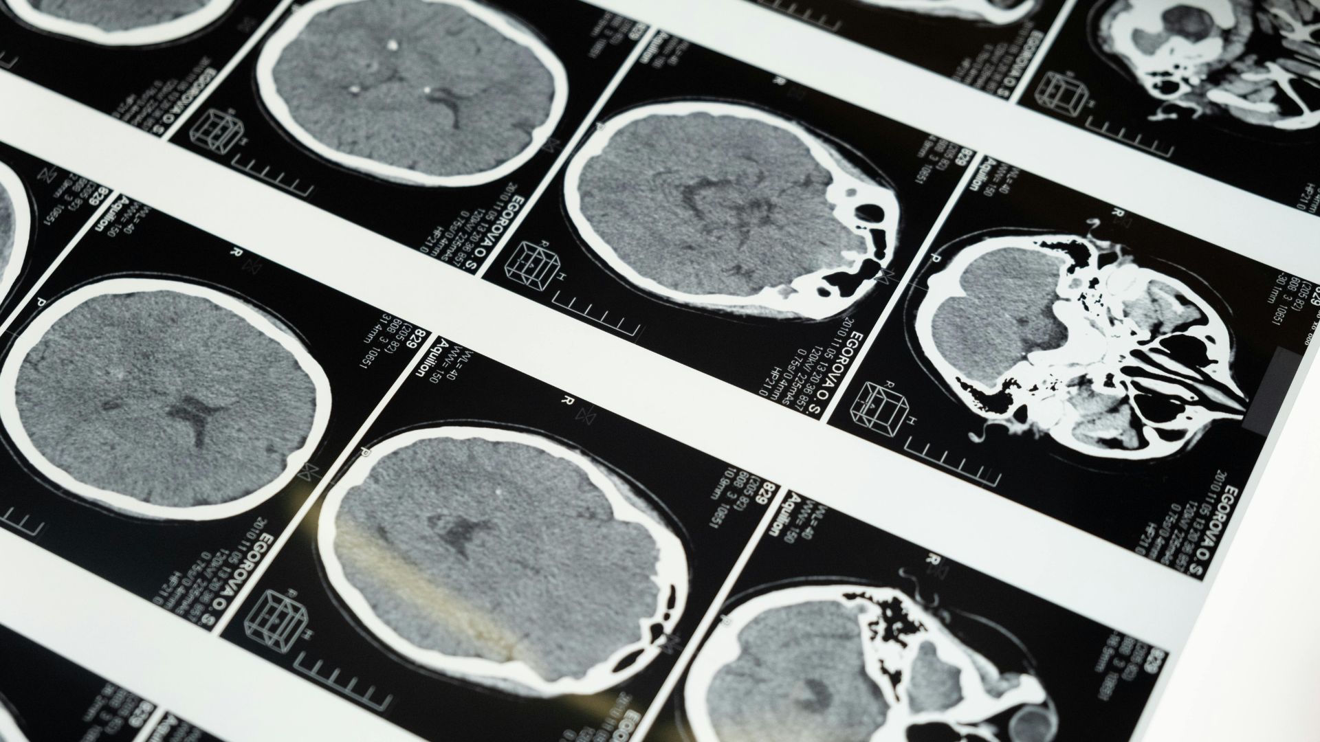 MRI scan images of the human brain displayed on a screen