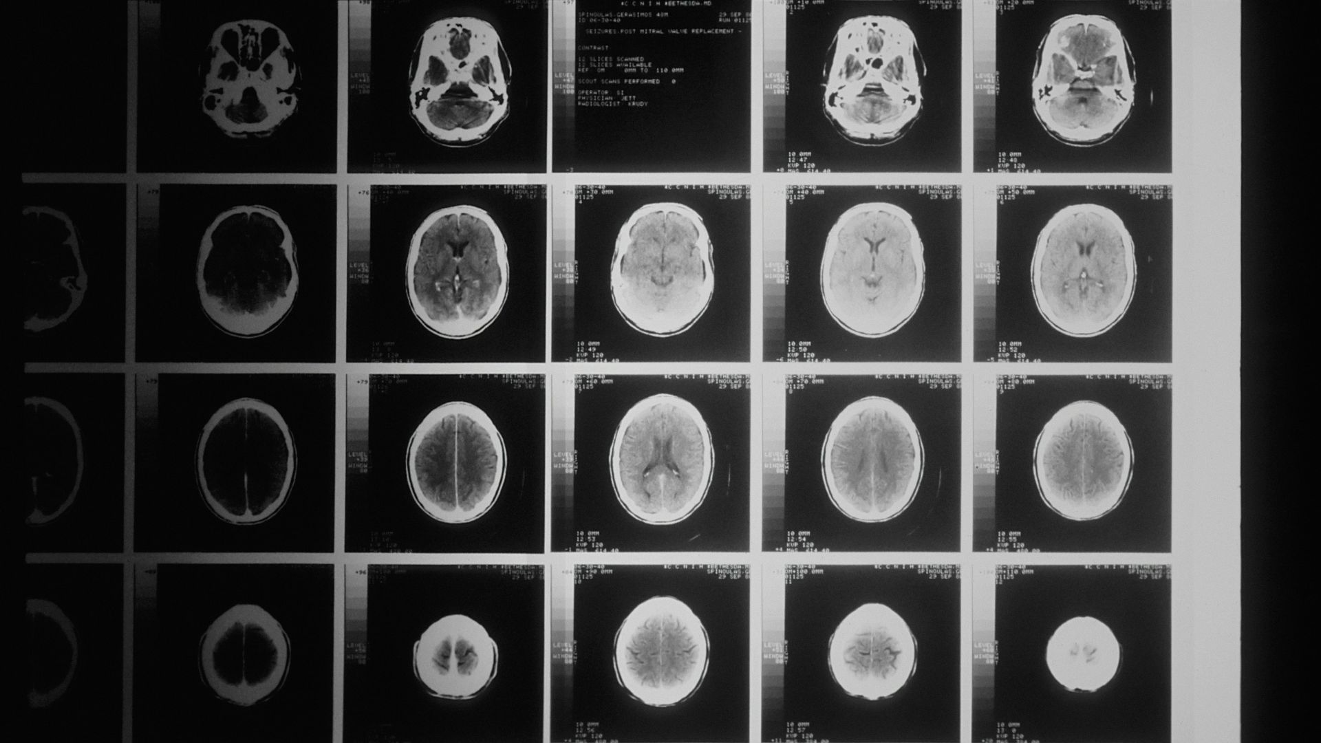 Black and white MRI brain scans displayed on a screen