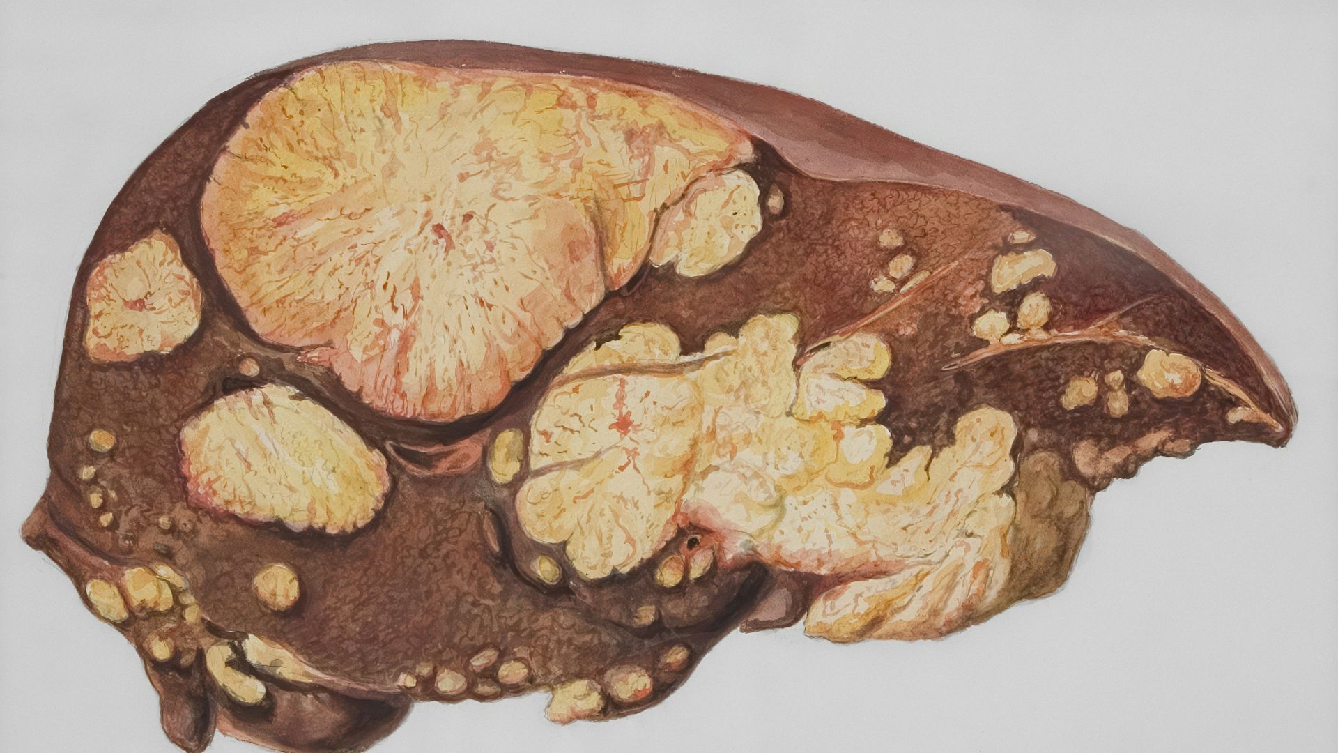 Medical illustration showing sections of a human brain in a clinical diagram style