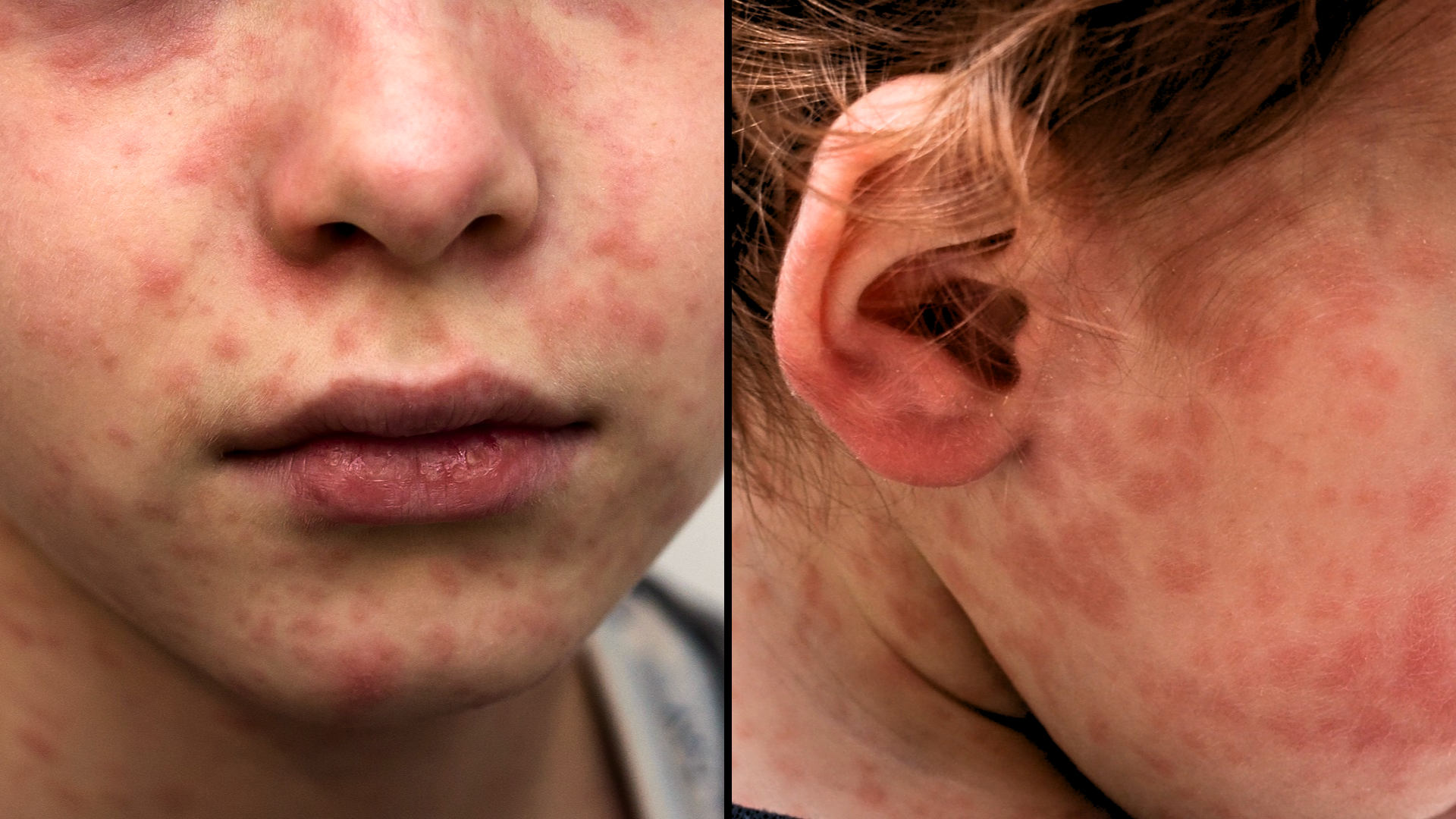 Close-up of child’s face and neck with red measles rash.