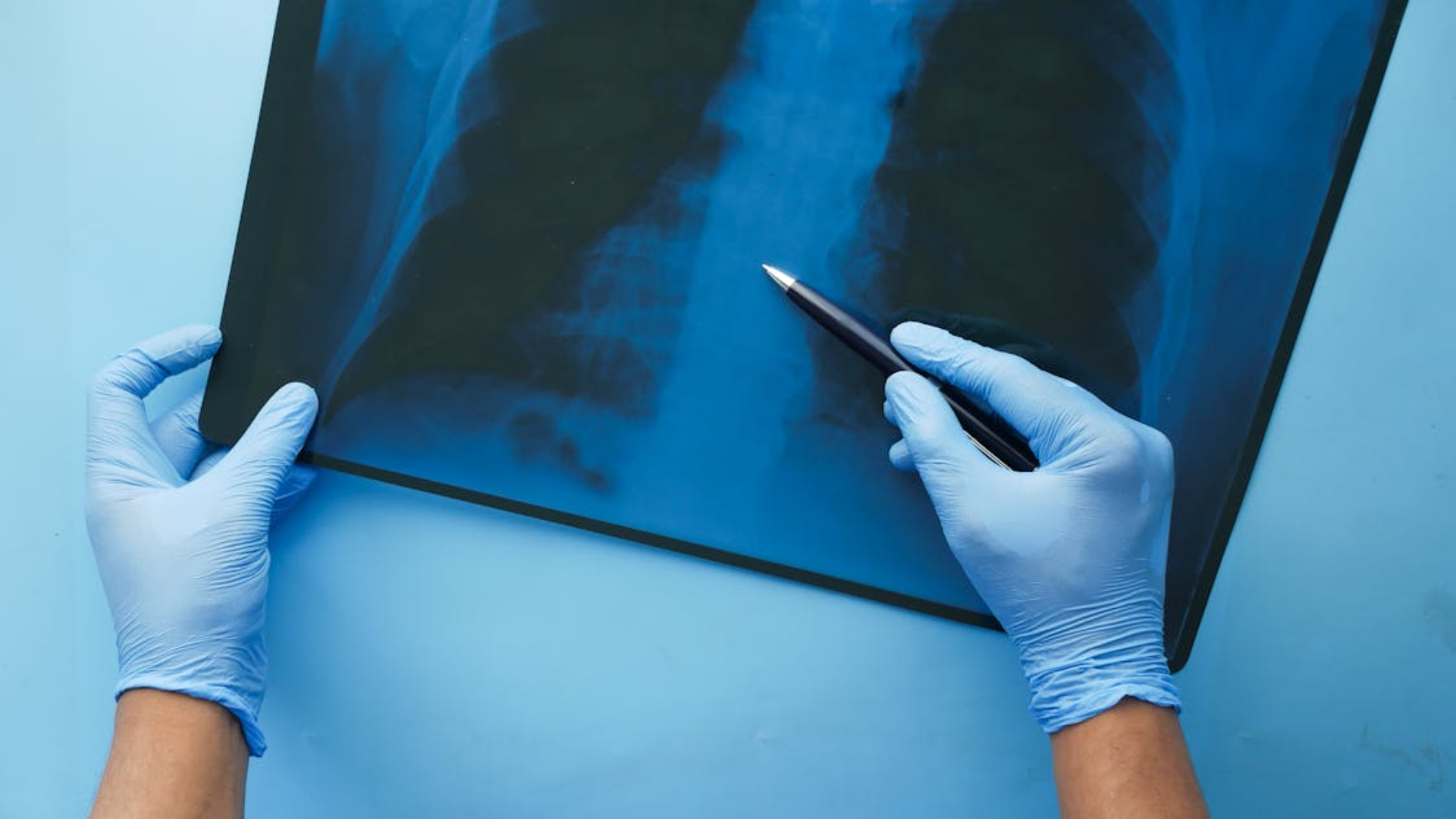A top-down view of a person in blue medical gloves using a pen to point at a chest X-ray against a light blue background.