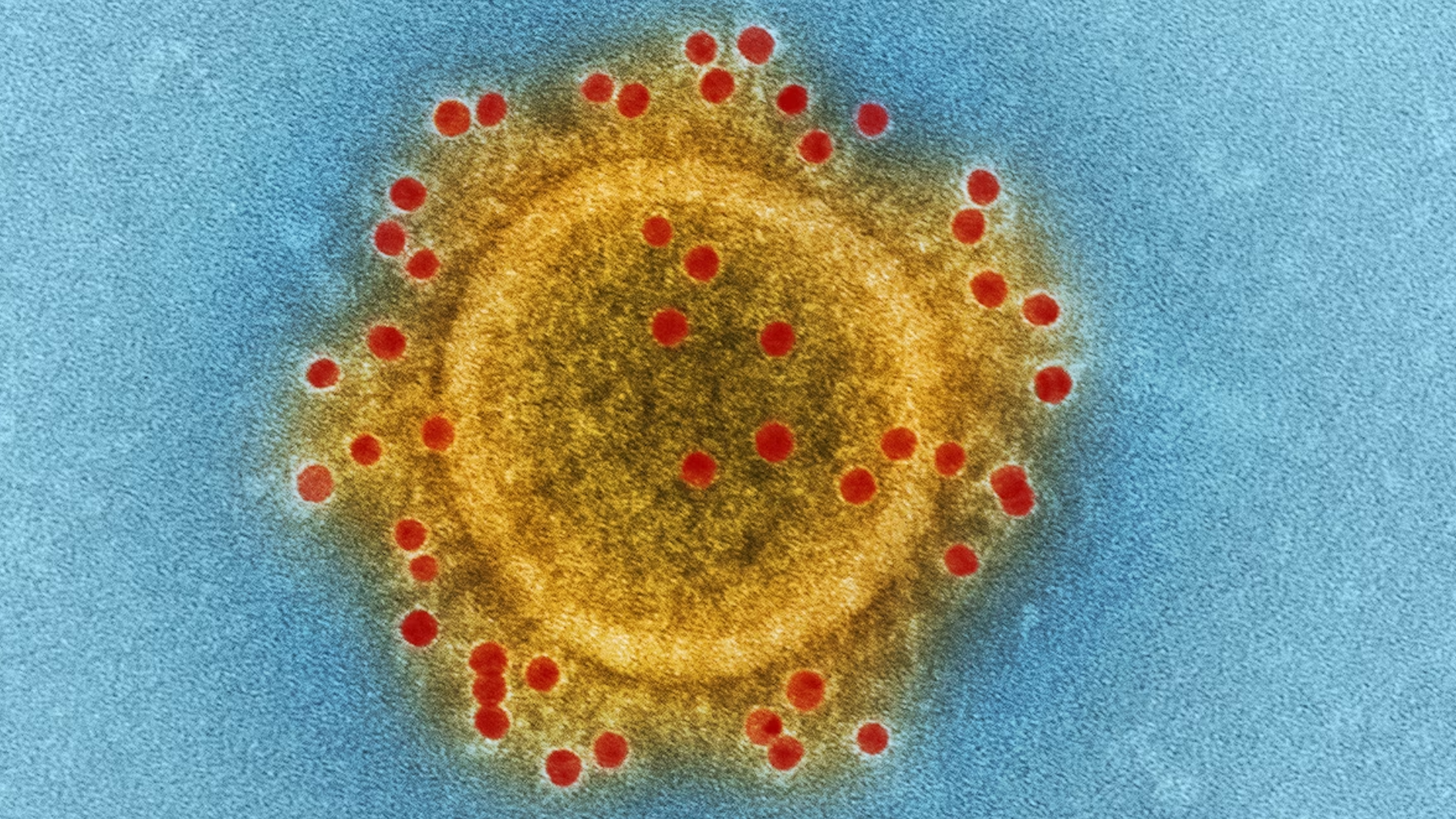 A colorized transmission electron micrograph of a single, spherical measles virus particle with a bright yellow core surrounded by a halo of red dot-like surface proteins.
