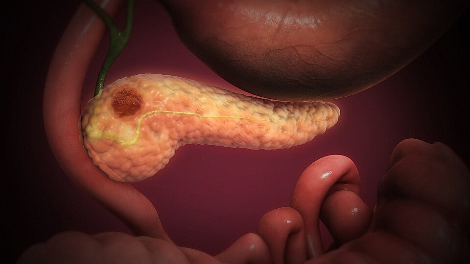 Medical illustration showing a tumor within the pancreas, highlighting the location and progression of pancreatic cancer within the digestive system.